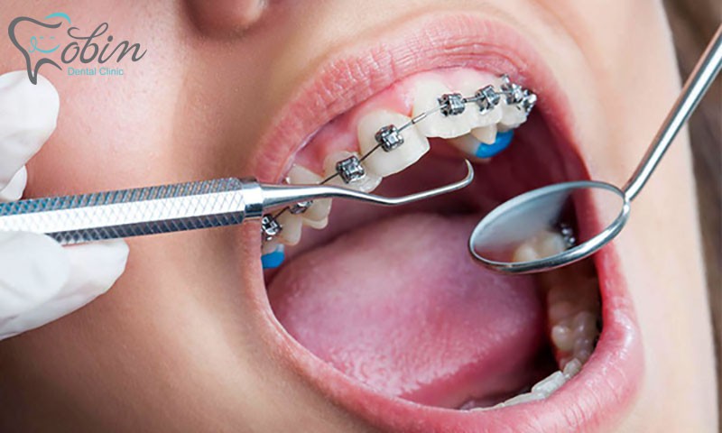 یکی از عواملی که باعث لق شدن دندان ها میشود، نحوه جاگذاری سیم ها و کلا سیستم ارتودنسی در داخل دهان است.